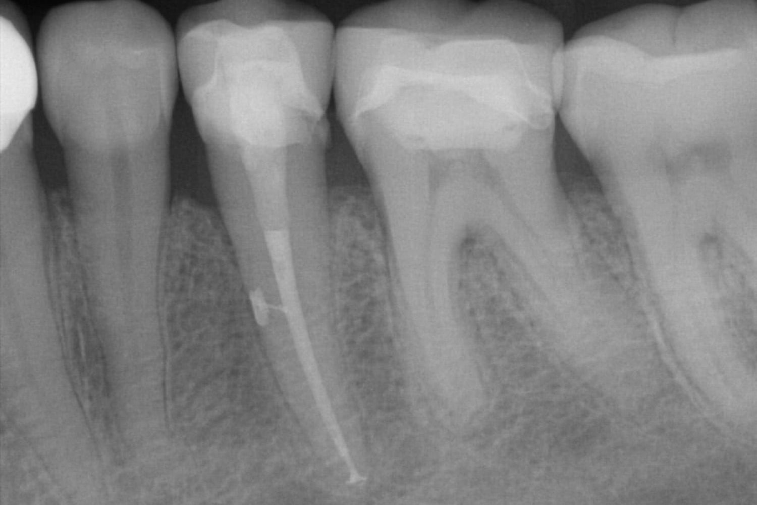 Endodontologie Wurzelbehandlung Röntgenbild