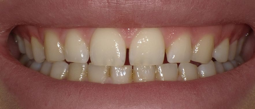 Veneers vorher