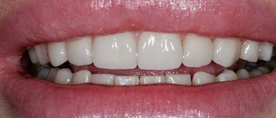 Veneers nachher